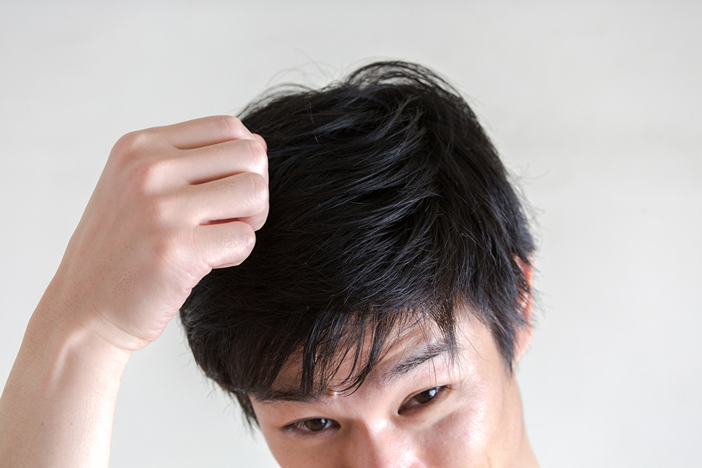 こんな症状はAGAかも?