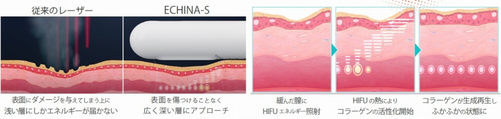 HIFU 膣縮小用医療機のメカニズム