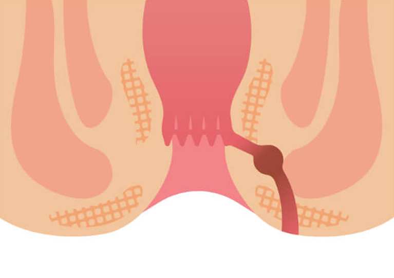 肛門周囲膿瘍